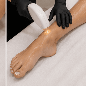 LASER FULL LEGS at Yadis Nails & Spa Laser in Austin, TX